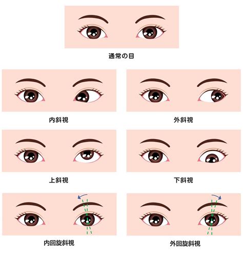 斜視|斜視の症状や原因、治療法とは？ 